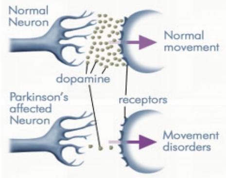 Nutrition Therapy for Parkinson’s Disease: Do’s and Don’ts